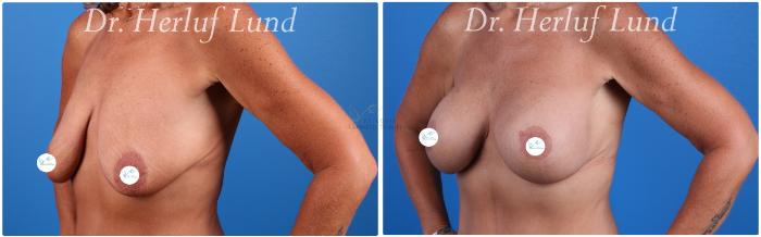 Before & After Breast Augmentation Case 442 Left Oblique View in St. Louis, MO