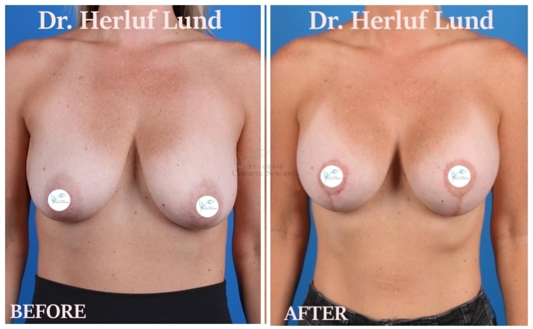 Before & After Breast Augmentation Case 443 Front View in St. Louis, MO