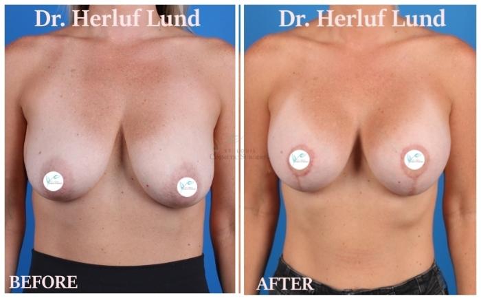 Before & After Breast Augmentation Case 443 Front View in St. Louis, MO