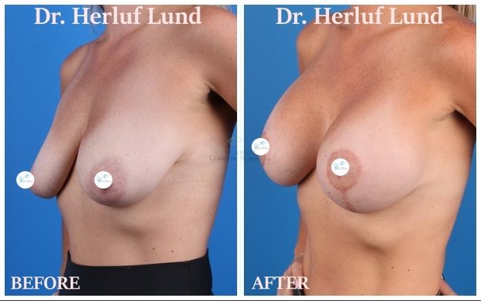 Before & After Breast Augmentation Case 443 Left Oblique View in St. Louis, MO