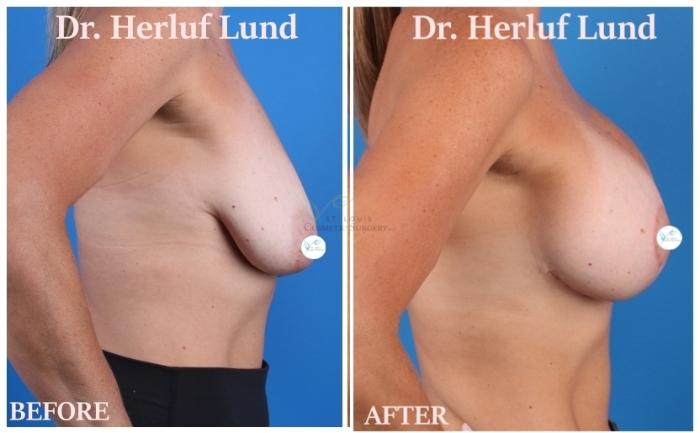 Before & After Breast Augmentation Case 443 Right Side View in St. Louis, MO