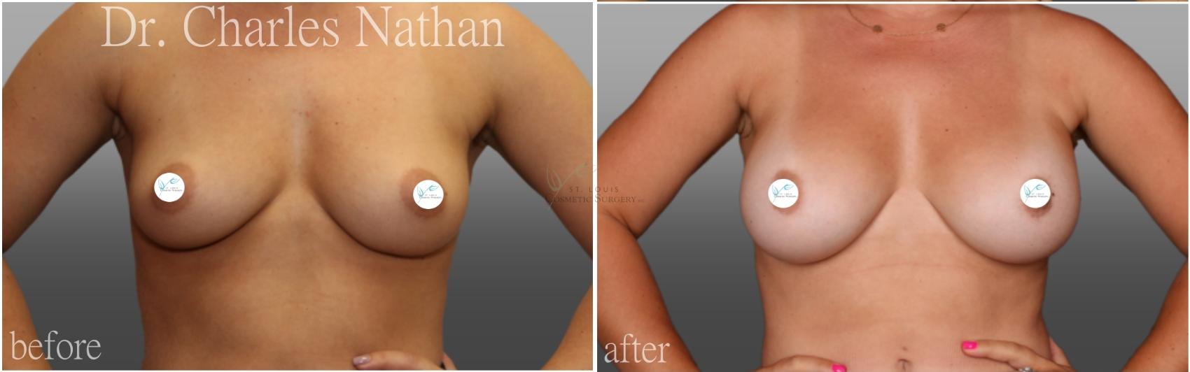 Before & After Breast Augmentation Case 444 Front View in St. Louis, MO