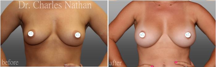 Before & After Breast Augmentation Case 444 Front View in St. Louis, MO