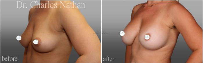 Before & After Breast Augmentation Case 444 Left Oblique View in St. Louis, MO