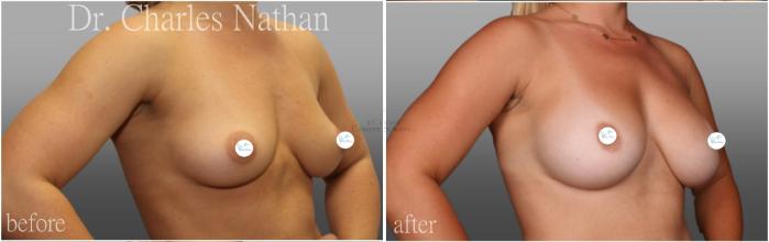 Before & After Breast Augmentation Case 444 Right Oblique View in St. Louis, MO