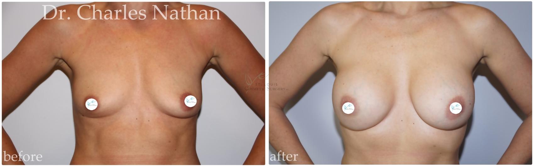 Before & After Breast Augmentation Case 447 Front View in St. Louis, MO