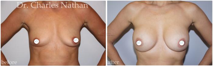 Before & After Breast Augmentation Case 447 Front View in St. Louis, MO
