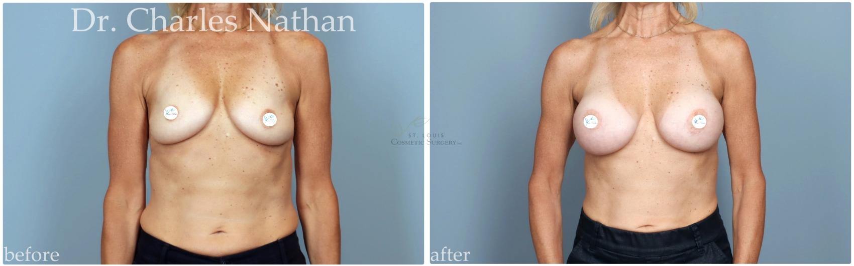 Before & After Breast Augmentation Case 448 Front View in St. Louis, MO