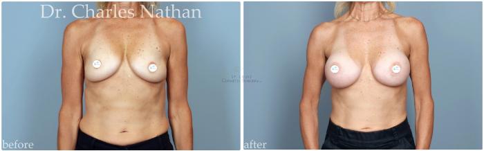 Before & After Breast Augmentation Case 448 Front View in St. Louis, MO