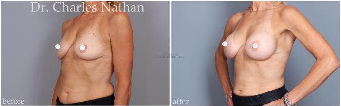 Before & After Breast Augmentation Case 448 Left Oblique View in St. Louis, MO