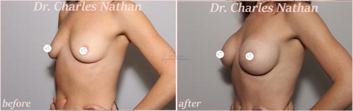 Before & After Breast Augmentation Case 450 Left Oblique View in St. Louis, MO