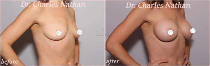 Before & After Breast Augmentation Case 450 Right Oblique View in St. Louis, MO