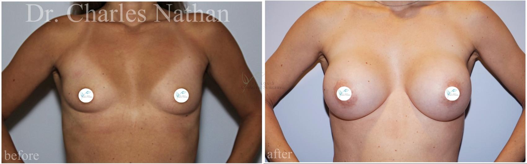 Before & After Breast Augmentation Case 457 Front View in St. Louis, MO