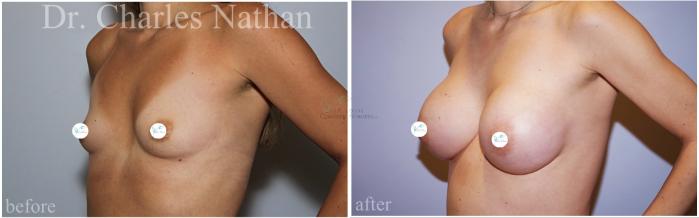 Before & After Breast Augmentation Case 457 Left Oblique View in St. Louis, MO