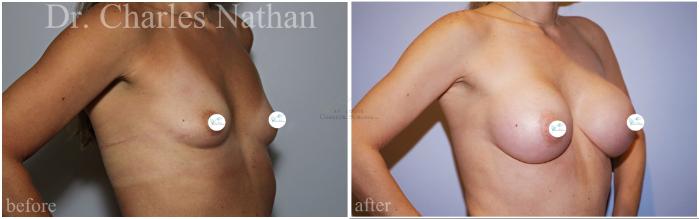 Before & After Breast Augmentation Case 457 Right Oblique View in St. Louis, MO