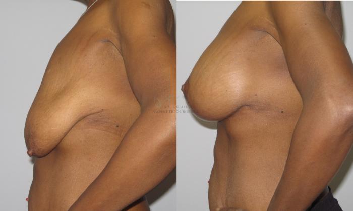 Before & After Breast Augmentation Case 46 View #2 View in St. Louis, MO