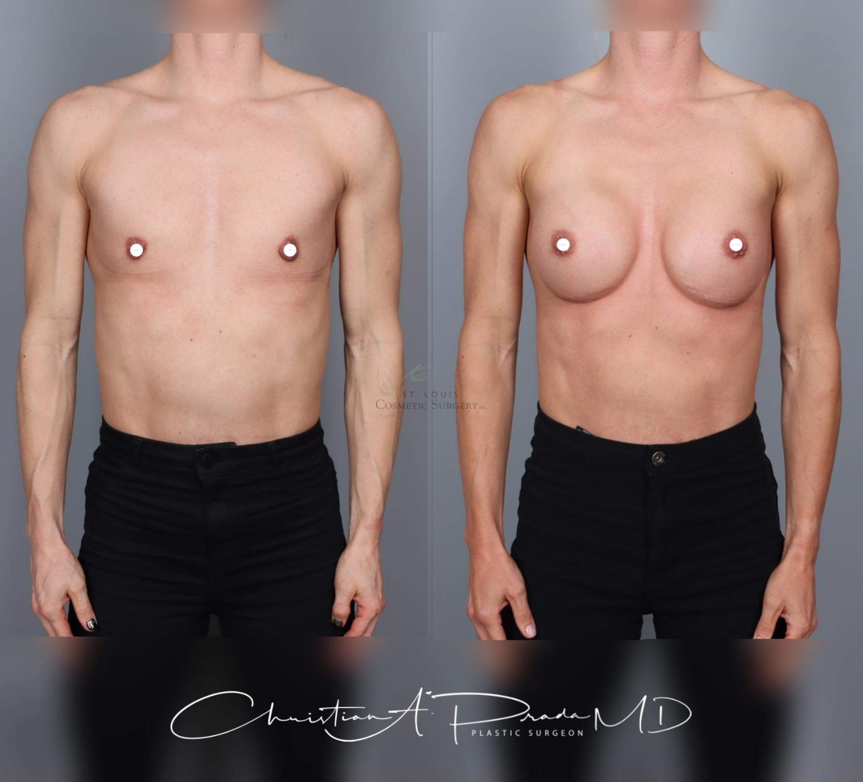 Before & After Breast Augmentation Case 463 Front View in St. Louis, MO