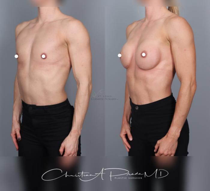 Before & After Breast Augmentation Case 463 Left Oblique View in St. Louis, MO