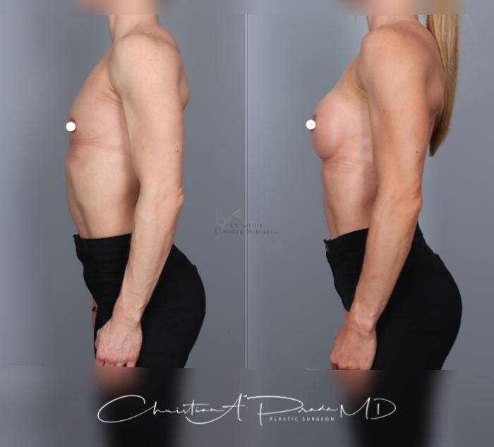 Before & After Breast Augmentation Case 463 Left Side View in St. Louis, MO