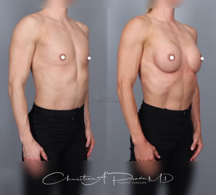 Before & After Breast Augmentation Case 463 Right Oblique View in St. Louis, MO