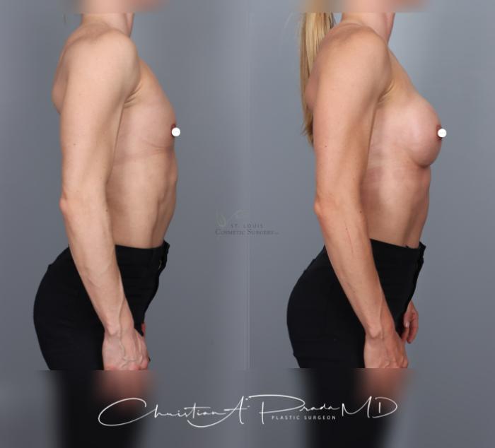 Before & After Breast Augmentation Case 463 Right Side View in St. Louis, MO