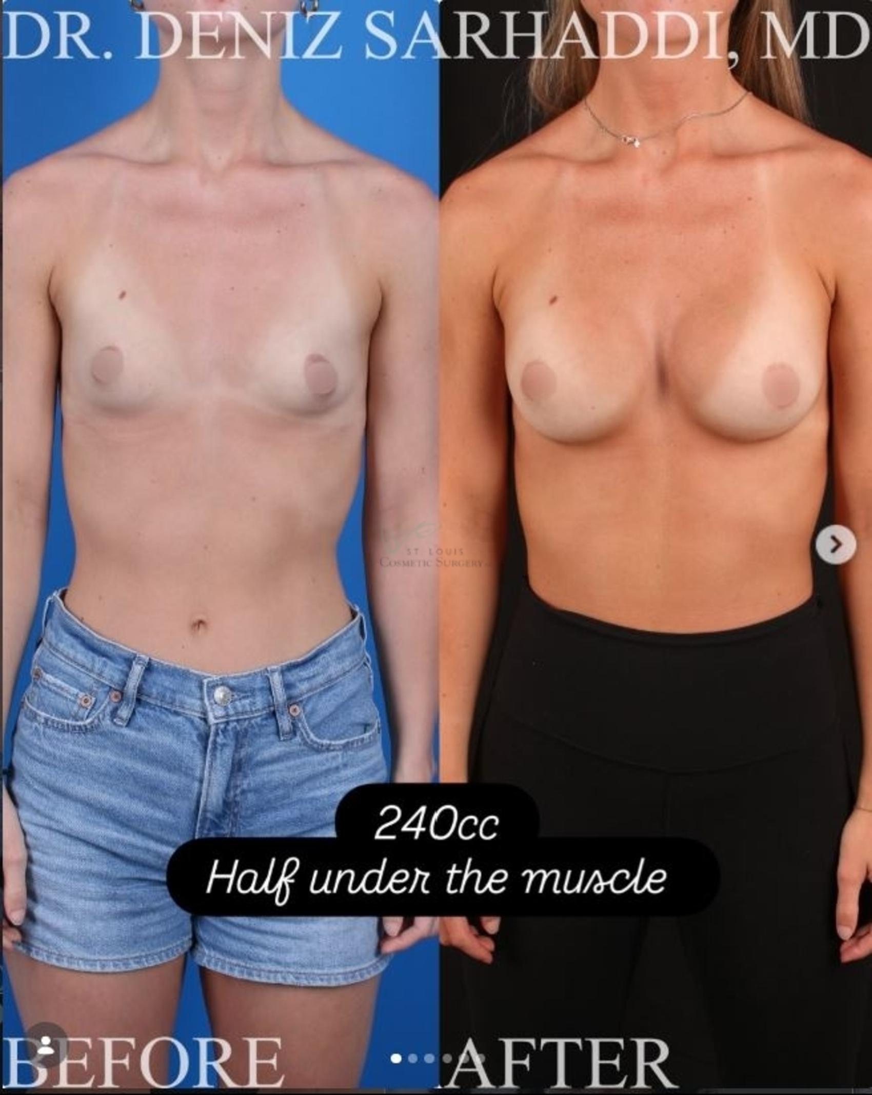 Before & After Breast Augmentation Case 466 Front View in St. Louis, MO