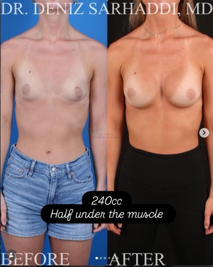 Before & After Breast Augmentation Case 466 Front View in St. Louis, MO