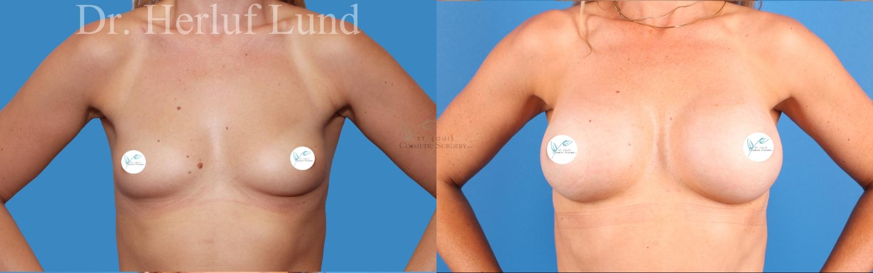 Before & After Breast Augmentation Case 472 Front View in St. Louis, MO