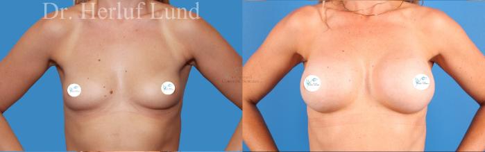 Before & After Breast Augmentation Case 472 Front View in St. Louis, MO