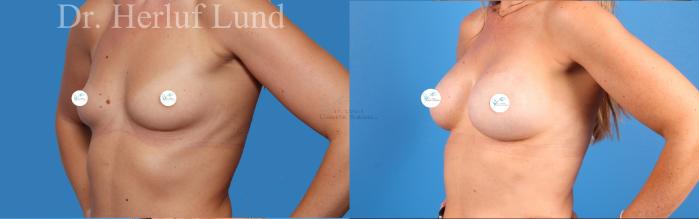 Before & After Breast Augmentation Case 472 Left Oblique View in St. Louis, MO