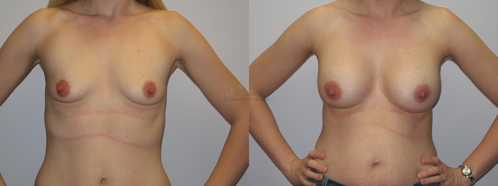 Before & After Breast Augmentation Case 48 View #1 View in St. Louis, MO