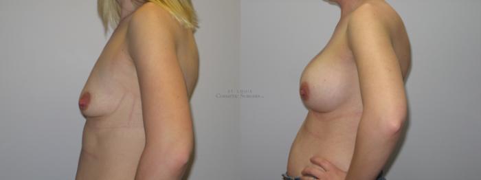 Before & After Breast Augmentation Case 48 View #2 View in St. Louis, MO