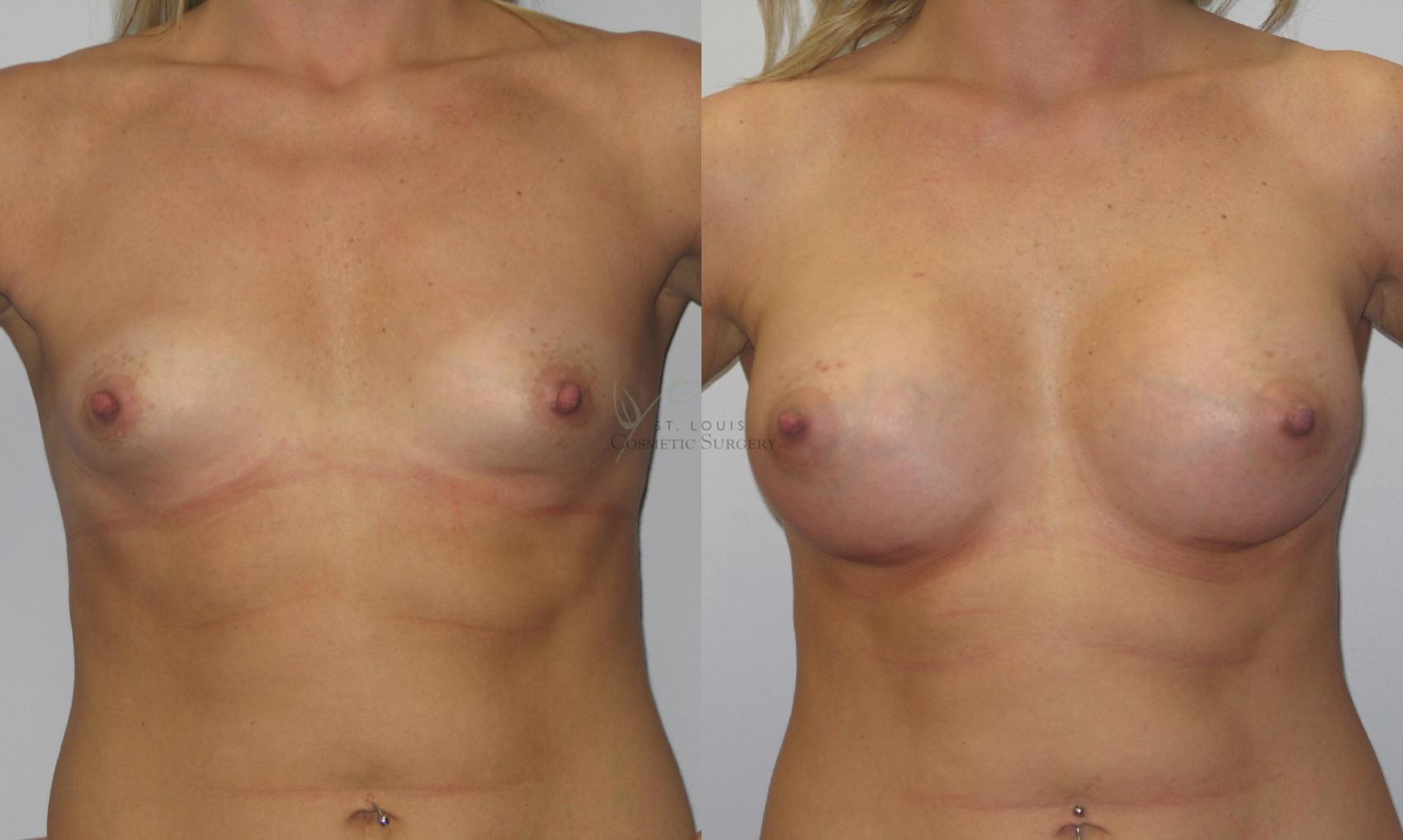 Before & After Breast Augmentation Case 50 View #1 View in St. Louis, MO
