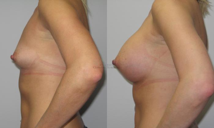 Before & After Breast Augmentation Case 50 View #2 View in St. Louis, MO