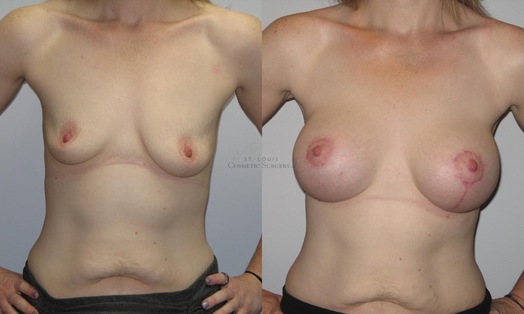 Before & After Breast Augmentation Case 56 View #1 View in St. Louis, MO