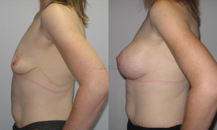 Before & After Breast Augmentation Case 56 View #2 View in St. Louis, MO