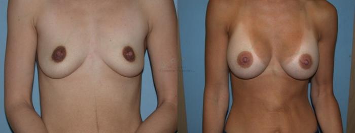 Before & After Breast Augmentation Case 58 View #1 View in St. Louis, MO