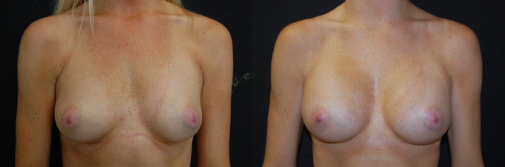 Before & After Breast Augmentation Case 59 View #1 View in St. Louis, MO