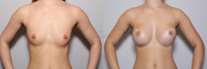 Before & After Breast Augmentation Case 63 View #1 View in St. Louis, MO