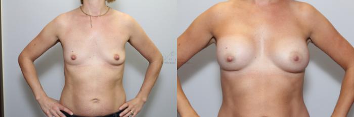 Before & After Breast Augmentation Case 64 View #1 View in St. Louis, MO