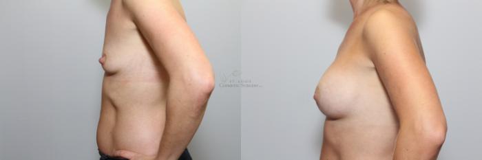 Before & After Breast Augmentation Case 64 View #2 View in St. Louis, MO
