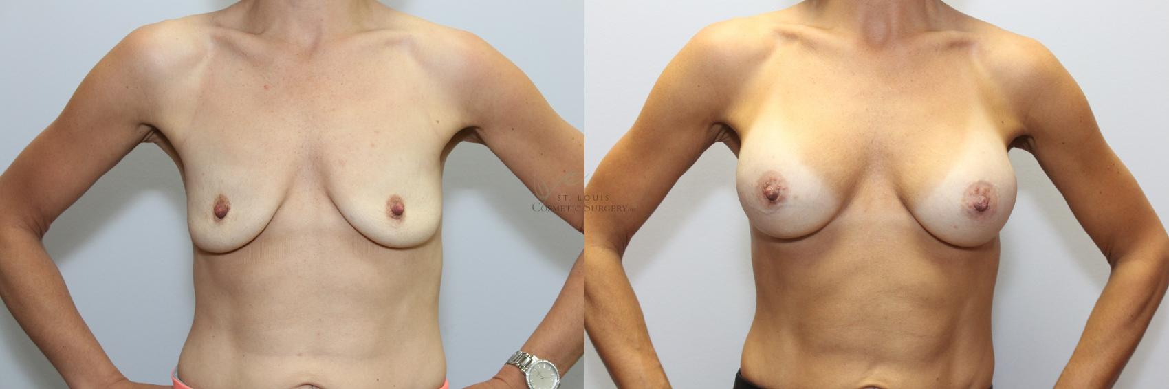 Before & After Breast Augmentation Case 68 View #1 View in St. Louis, MO