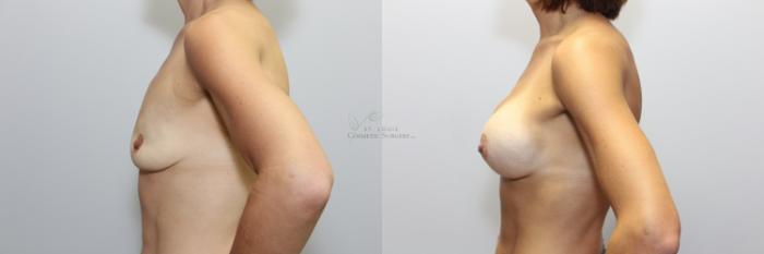 Before & After Breast Augmentation Case 68 View #2 View in St. Louis, MO