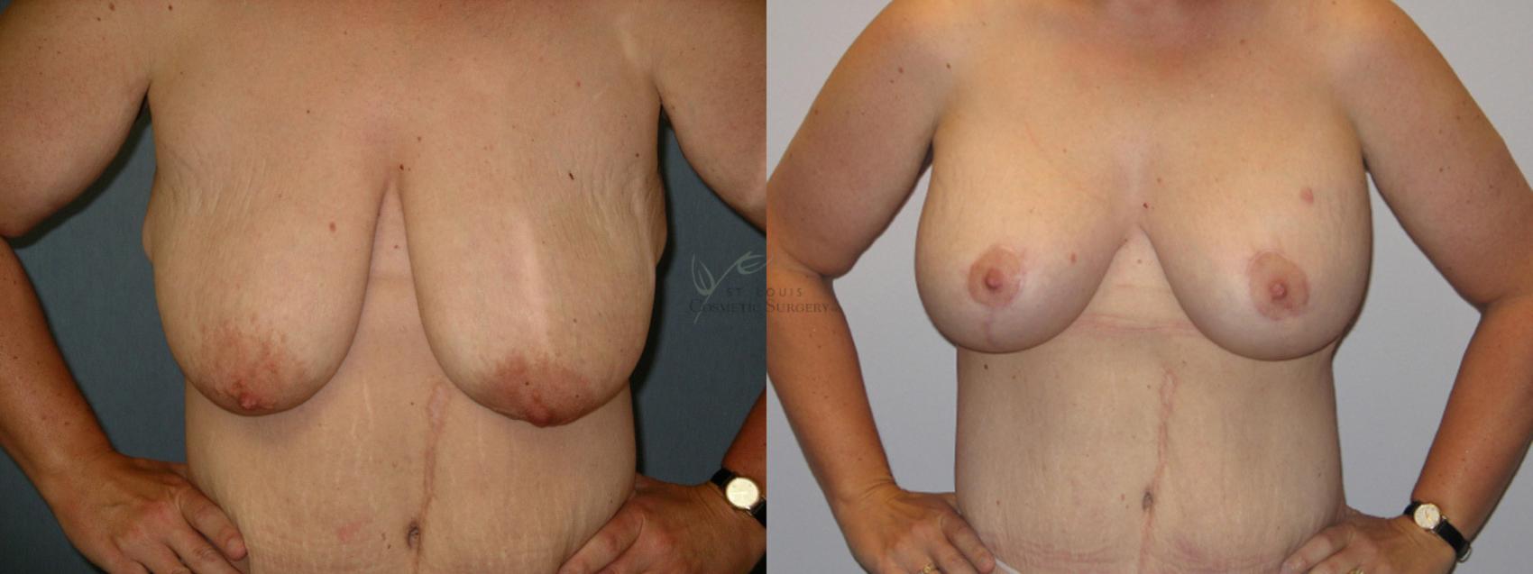 Before & After Breast Augmentation Case 7 View #1 View in St. Louis, MO