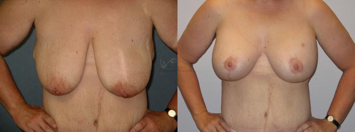Before & After Breast Augmentation Case 7 View #1 View in St. Louis, MO