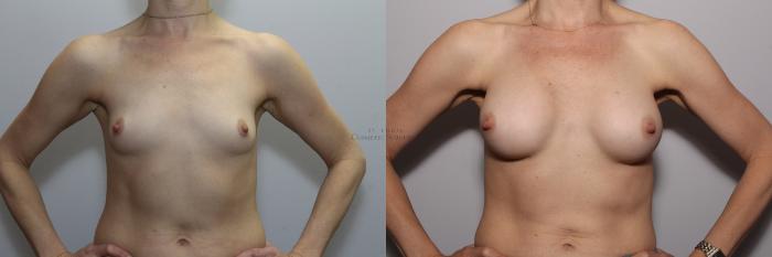 Before & After Breast Augmentation Case 79 View #1 View in St. Louis, MO