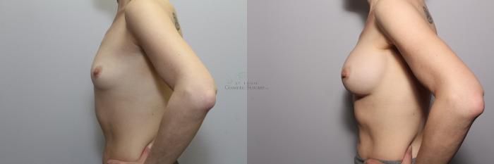 Before & After Breast Augmentation Case 79 View #2 View in St. Louis, MO