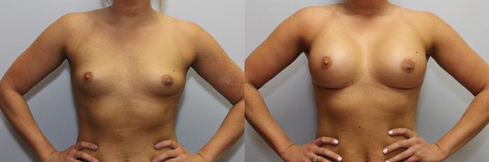 Before & After Breast Augmentation Case 83 View #1 View in St. Louis, MO