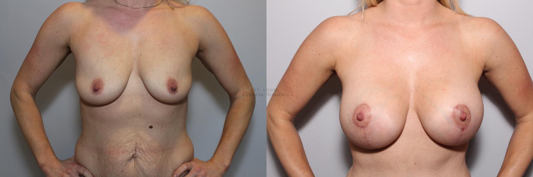 Before & After Breast Augmentation Case 84 View #1 View in St. Louis, MO