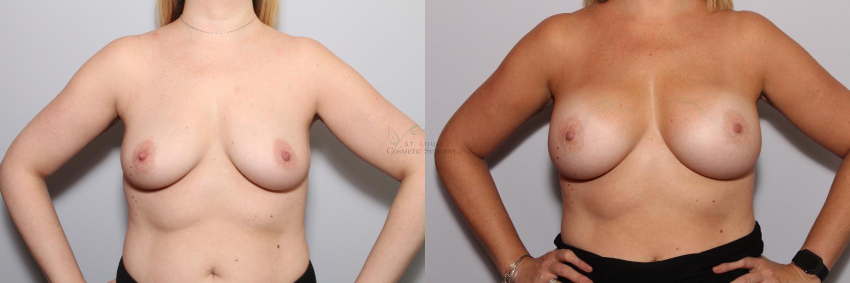 Before & After Breast Augmentation Case 85 View #1 View in St. Louis, MO